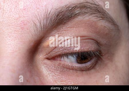 Xanthelasma,  elevated yellowish growth on the eyelids, macro shot Stock Photo