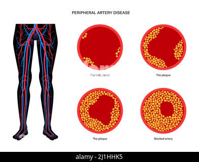 Peripheral artery disease, illustration Stock Photo - Alamy