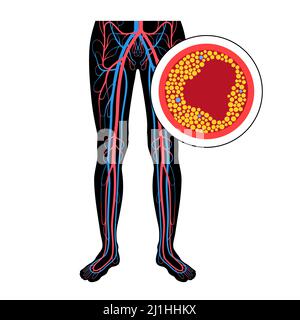 Peripheral artery disease, illustration Stock Photo - Alamy