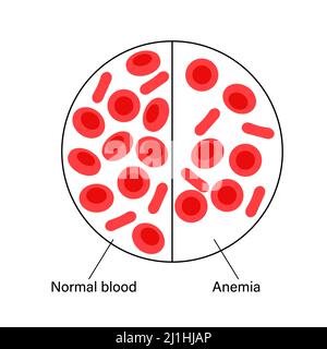 Normal blood and anaemic blood, illustration Stock Photo - Alamy