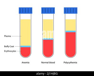 Normal and diseased blood composition, illustration Stock Photo - Alamy