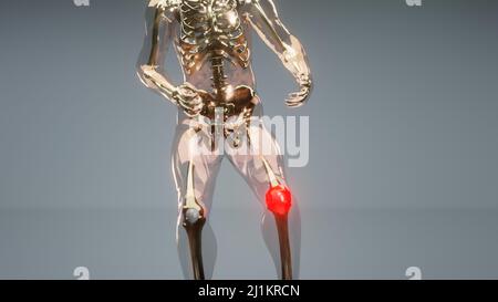 Knee sprain or ache leading to pain, man suffering from knee pain, Healthy joint and unhealthy painful joint with osteoarthritis, xray hologram Stock Photo