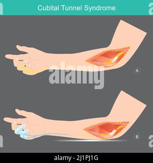 Cubital Tunnel Syndrome. A condition that involves pressure or stretching of the ulnar nerve in arms which can cause numbness or tingling in the ring Stock Vector