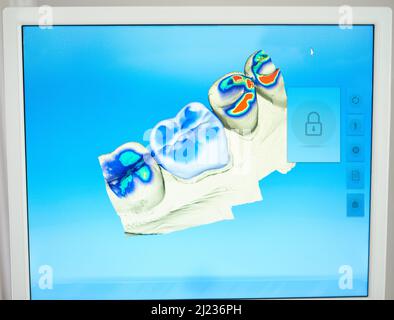 Monitoring your teeth. Shot of a scan of teeth for cavities on a monitor. Stock Photo