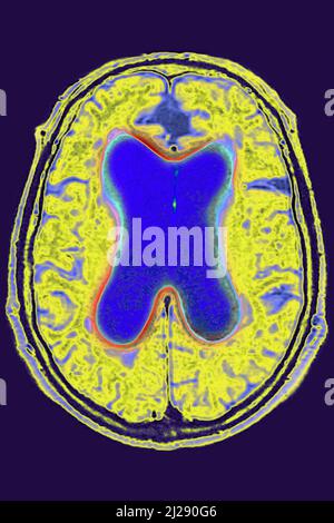 Hydrocephalus exvacuo Stock Photo