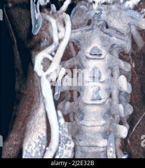 Stenosis of the carotid, 3d scan Stock Photo