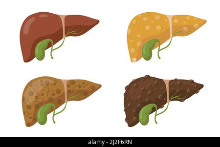 Disease stages of human liver flat set for web design. Cartoon liver in different conditions isolated on white background vector illustration collecti Stock Vector