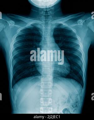 Chest X-ray image of Covid-19 patient in blue tone picture on black background Stock Photo