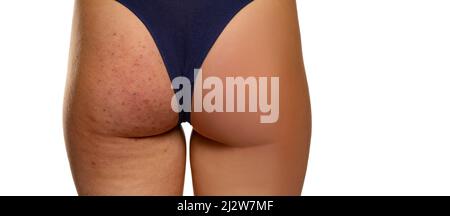 Female buttocks before and after treatment on white background Stock Photo