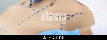 Doctor plastic surgeon drawing preoperative markings on skin of patient abdomen closeup Stock Photo