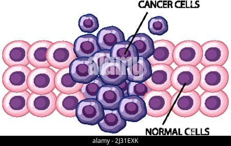 Process of cancer cell development illustration Stock Vector