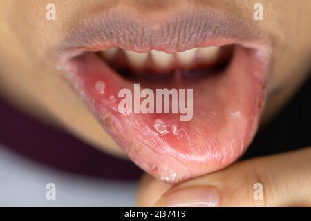 Mouth ulcers HIV Stock Photo - Alamy