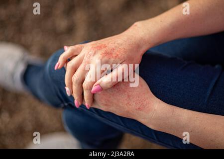 Close up dermatitis on skin, ill allergic rash eczema skin of patient , atopic dermatitis symptom skin detail texture , Fungus of skin ,The concept de Stock Photo