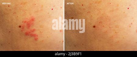 Photo before and after skin irritation treatment. Rash on a woman skin. Stock Photo