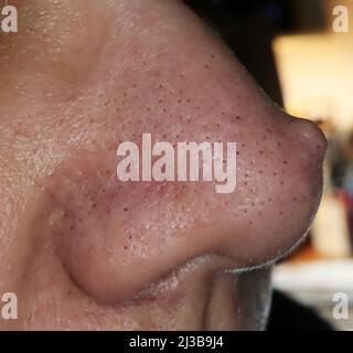 Female nose with wart or papilloma. Macro photo, selective focus Stock Photo