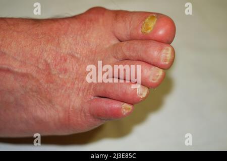 Toenails with fungal nail infection Stock Photo