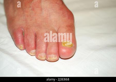 Toenails with fungal nail infection Stock Photo