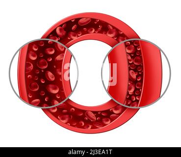 Hypertension And High Blood pressure as a medical diagram concept with a normal and abnormal hypertensive blood cell flow and human circulation. Stock Photo