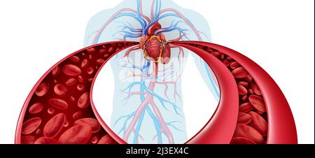 Hypertension And High Blood pressure as a medical diagram concept with a normal and abnormal hypertensive blood cell flow and human circulation. Stock Photo