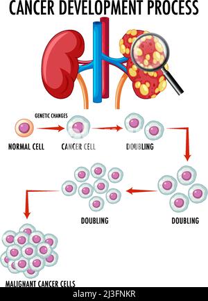 Diagram showing cancer development process illustration Stock Vector ...