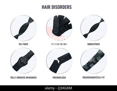 Hair disorder types, illustration Stock Photo