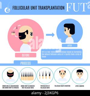 FUT hair transplantation in men, illustration Stock Photo