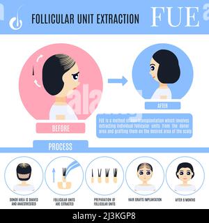 FUE hair transplantation in women, illustration Stock Photo