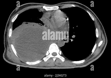 Pleural empyema, CT scan Stock Photo