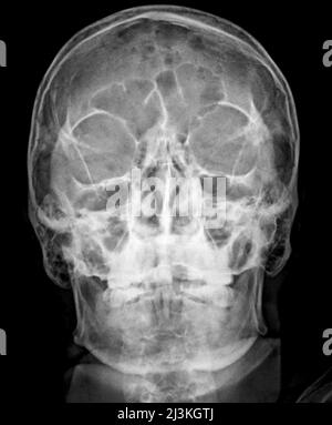 Multiple myeloma of the skull, X-ray Stock Photo - Alamy