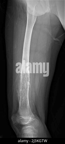 Femur osteosarcoma, X-ray Stock Photo