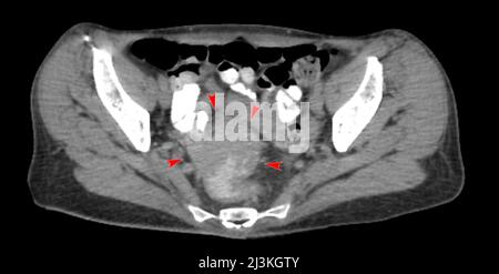 Rectal cancer, CT scan Stock Photo
