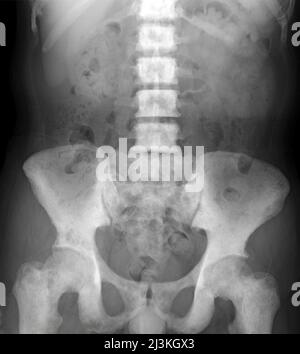 Bone Metastases Images and Xrays