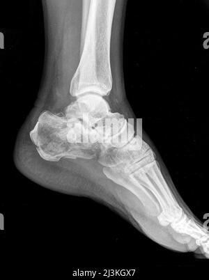 Anterior hot sale calcaneal spur