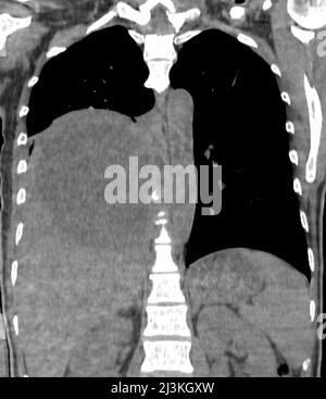 Pleural empyema, CT scan Stock Photo