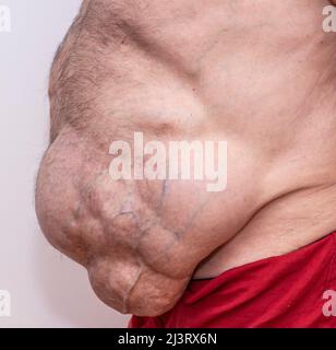 Close up of abdominal incisional hernia. Side view. Stock Photo