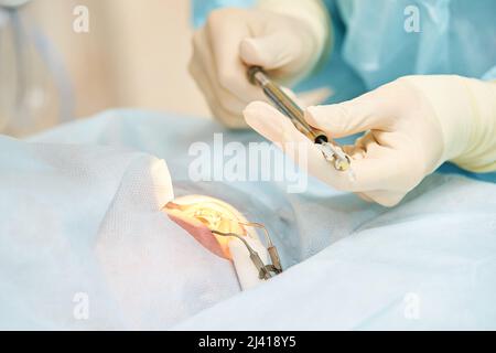 Ophthalmology laser microscope operation. Doctor surgery in clinic. Patient eye treatment. Myopia and cataract removal. Medical vision prp lasik Stock Photo