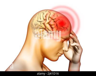 Medical illustration about pain located in the head area. Digital illustration. Stock Photo