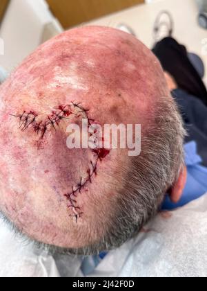 Scars after squamous cell carcinoma of scalp surgery Stock Photo