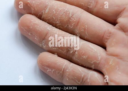 Is the skin around your nails peeling? know causes behind it – India TV
