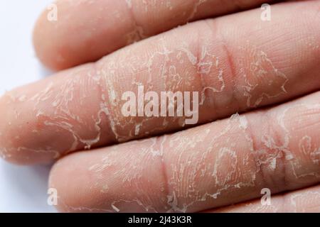 allergies - Why does my hand skin continue to crack and peel for days after  rock climbing? - The Great Outdoors Stack Exchange