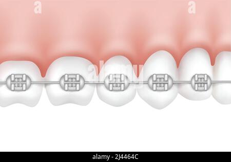 Vector human teeth with metal braces side view isolated on white background Stock Vector