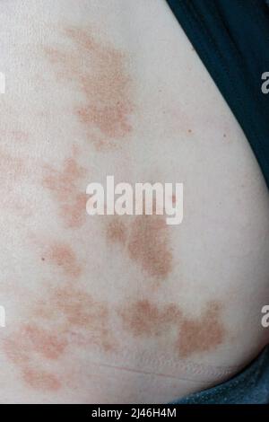 Red-brown spots on the skin of a woman near the abdomen. Stock Photo