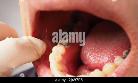 Decayed tooth root canal treatment. Tooth or teeth decay of lower molar. Restoration with a composite filling. Adult caries. bad teeth. Dental tempora Stock Photo