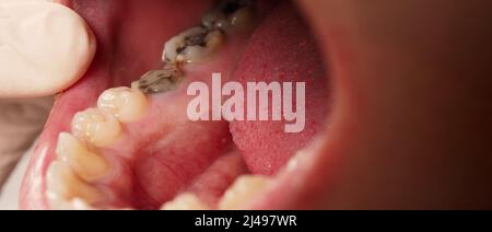 Decayed tooth root canal treatment. Tooth or teeth decay of lower molar. Restoration with a composite filling. Adult caries. bad teeth. Dental tempora Stock Photo