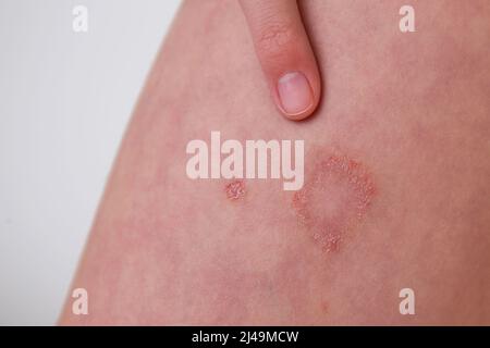 The child has allergic contact dermatitis on the skin. Stock Photo