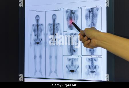 Doctor hand pointing on skeleton x-ray film. Stock Photo