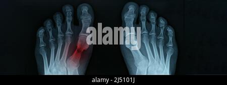X ray of feet with tarsal fracture closeup Stock Photo