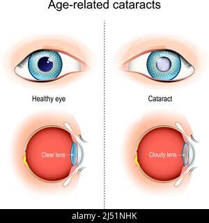 cataracts. Age-related vision problems. Cross-sectional view, showing the position of the human lens. vector illustration Stock Vector
