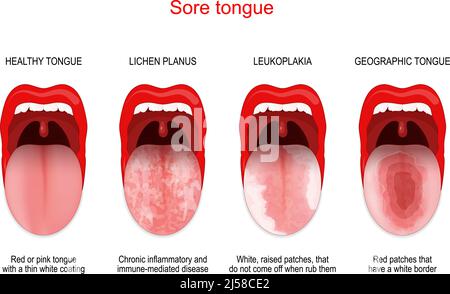 Sore or white tongue. comparison of healthy tongue and oral disease: Lichen planus, Leukoplakia, Geographic tongue. Vector poster for medical use Stock Vector