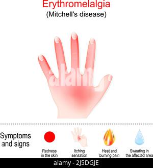 Erythromelalgia is a rare condition that causes episodes of burning pain and redness in the  hands and other body parts. Mitchell's disease in left ha Stock Vector